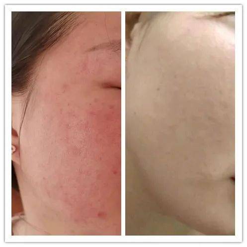 脸上长斑还有红血丝是什么原因?这几种情况需注意!_皮肤_肌肤_化妆品