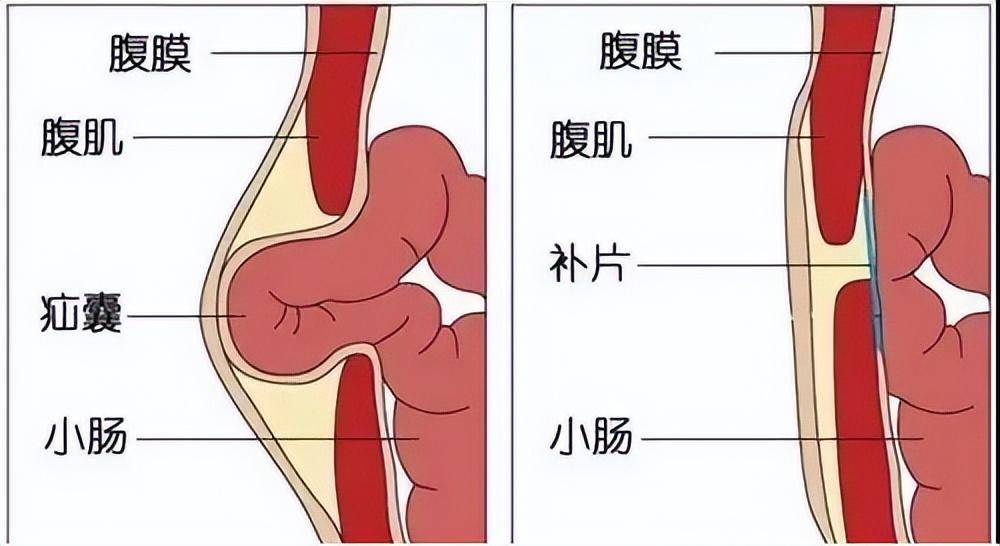 肿块主要因腹腔内的器官脱出至疝气袋形成,因脱出的器官以小肠居多