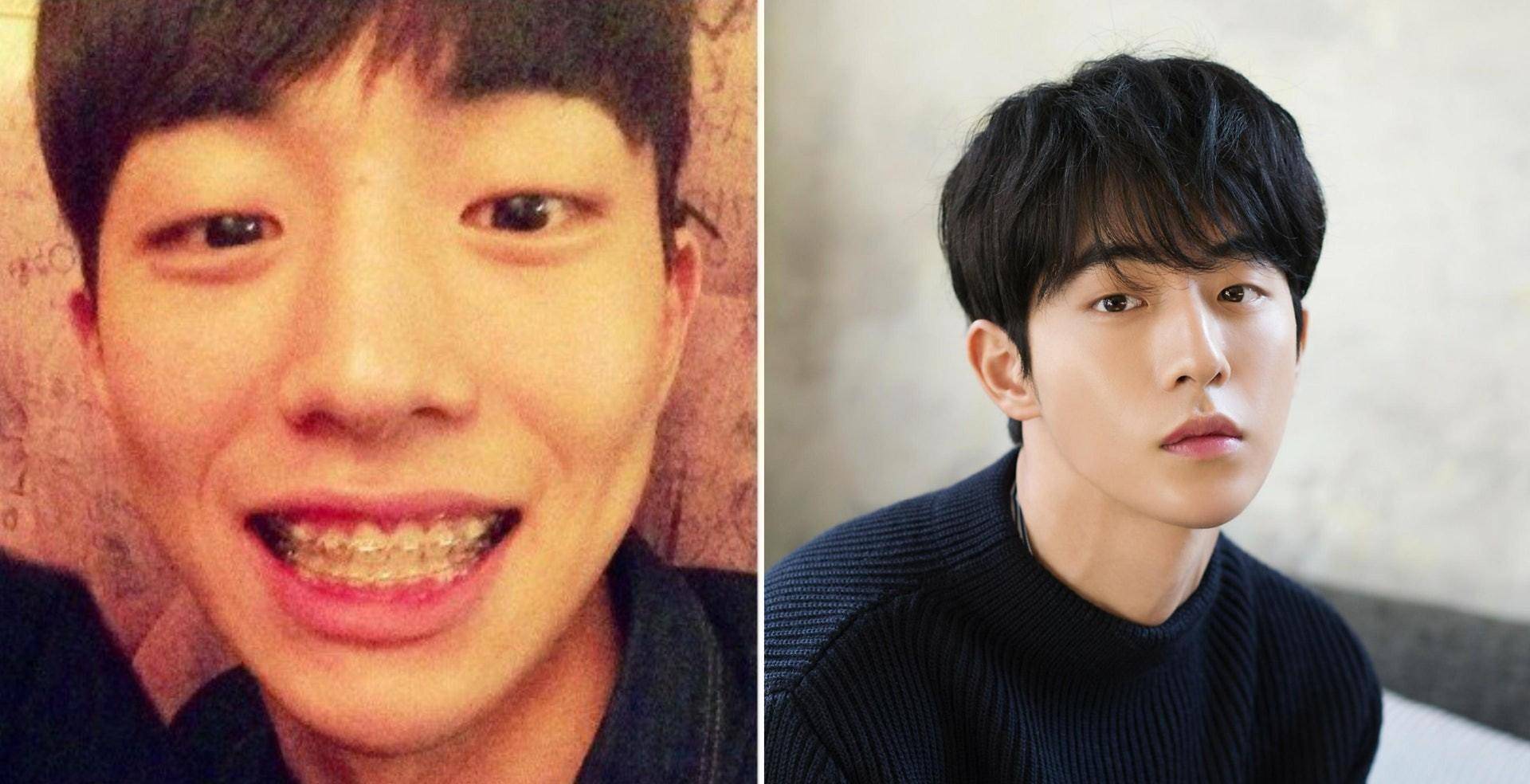 但感觉戴牙套似乎也给他留下了一些不好的"心理阴影",很多照片的唇部