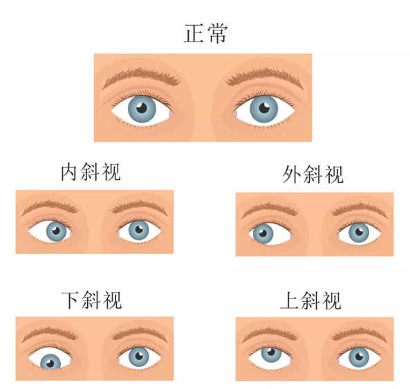 昆明普瑞眼科儿童斜视怎么纠正