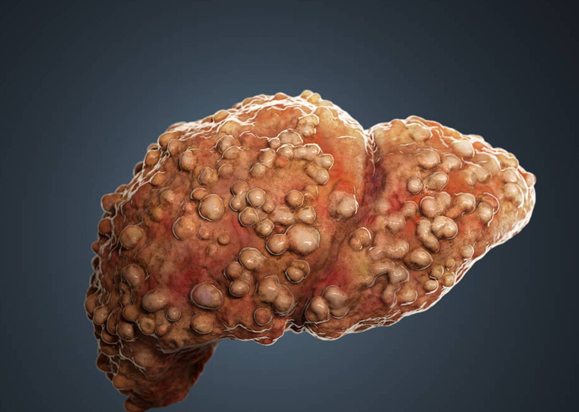 若是一个不占,恭喜你肝还不错_肝脏_颜色_尿液