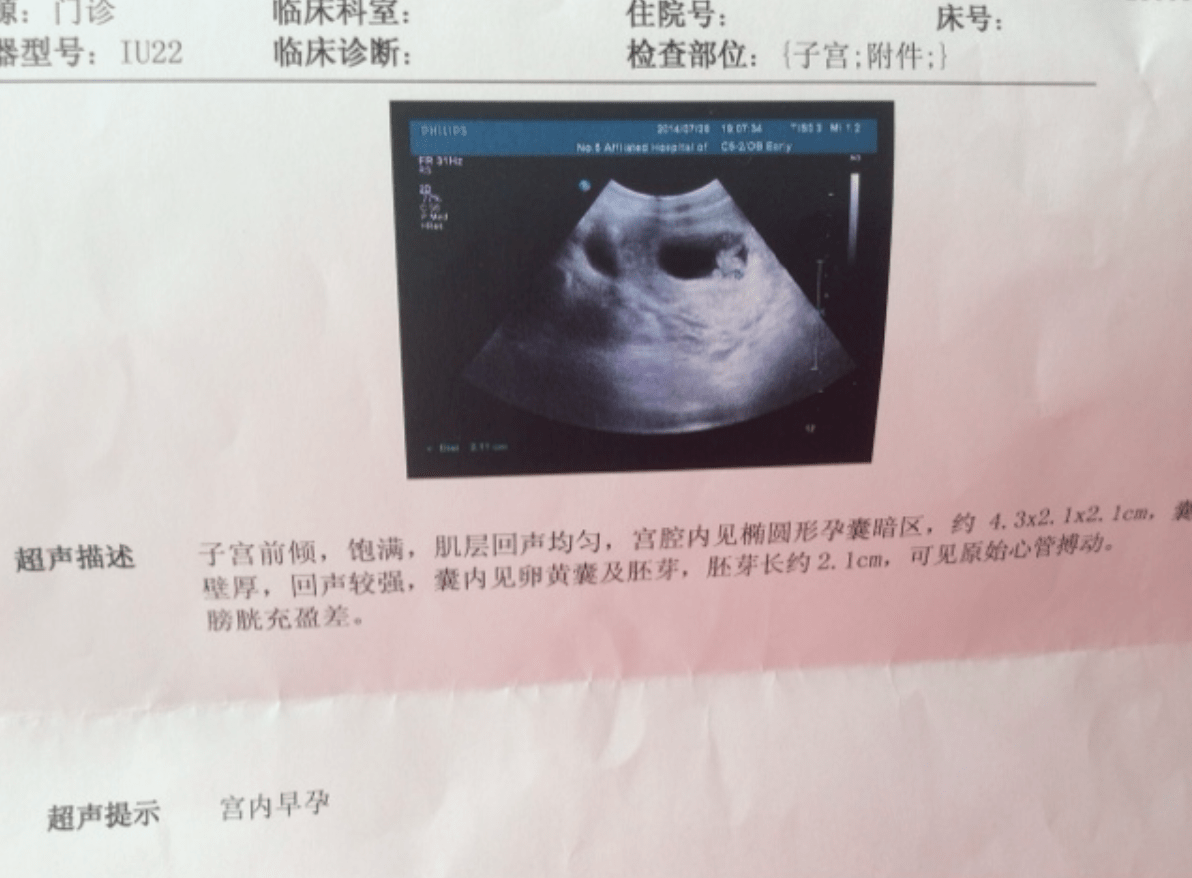 宫外孕b超单子图片图片