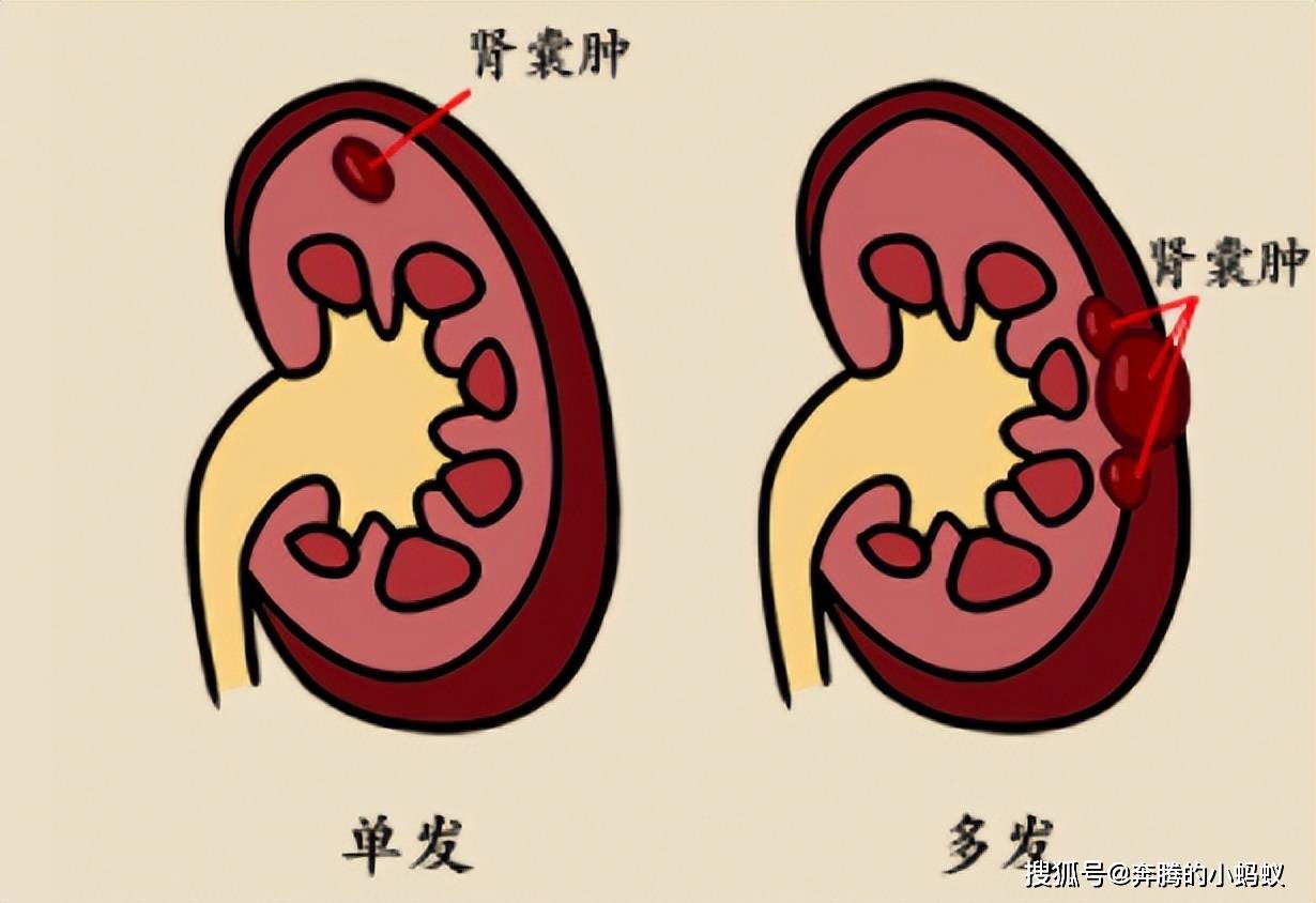 应该如何预防治疗肾囊肿?