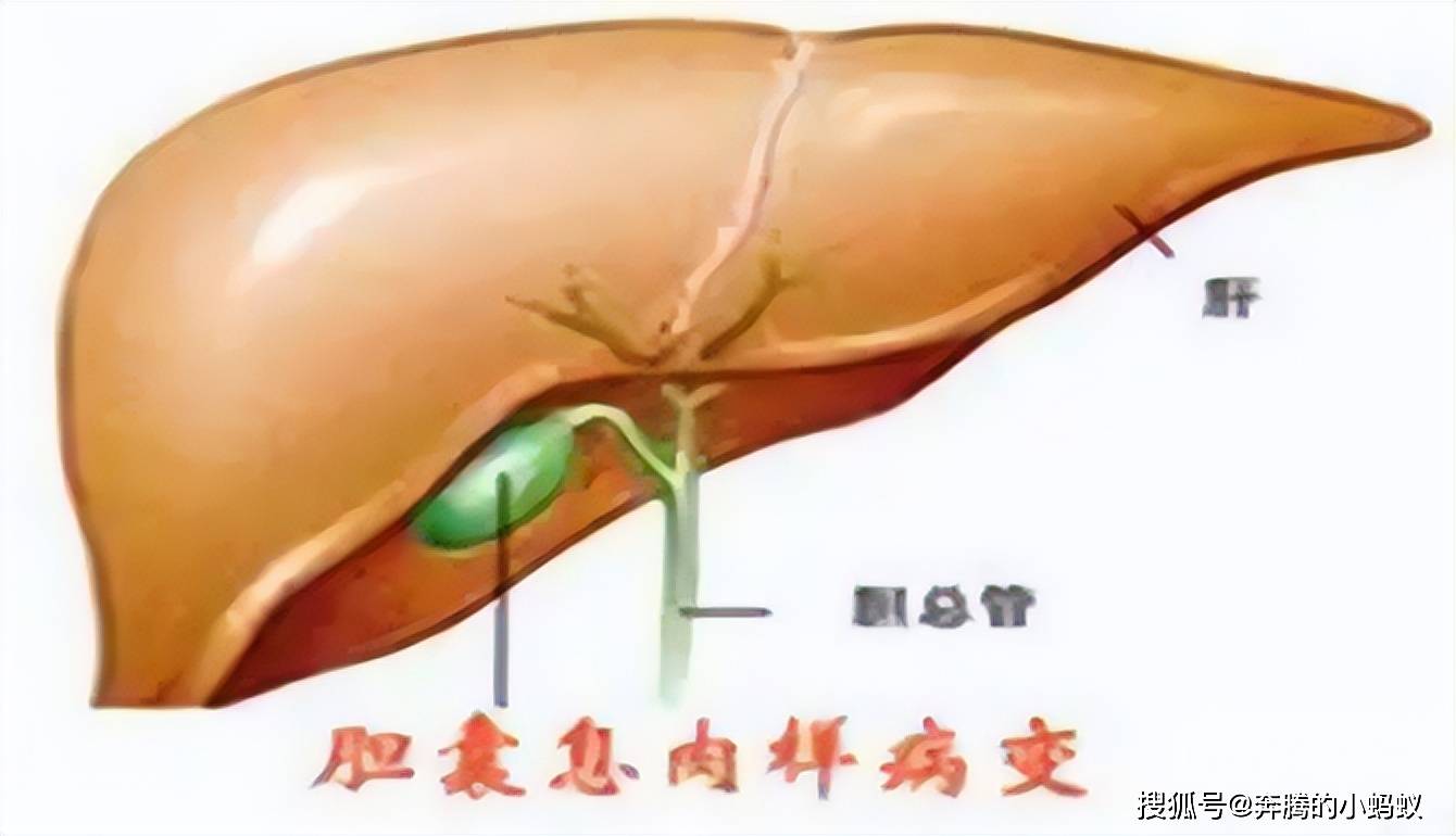 胆囊真的是可有可无吗得了胆囊息肉这些问题一定要知道