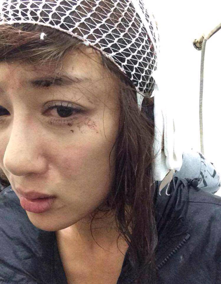 知否中曼娘扮演者李依晓美女,竟被知名女星的狗咬重伤,太心疼了_叶璇