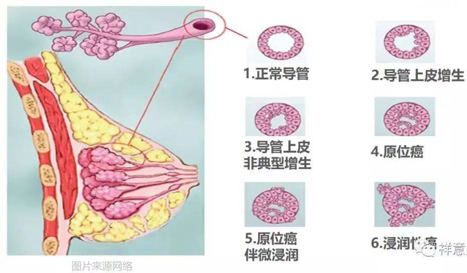 乳腺导管扩张什么意思图片