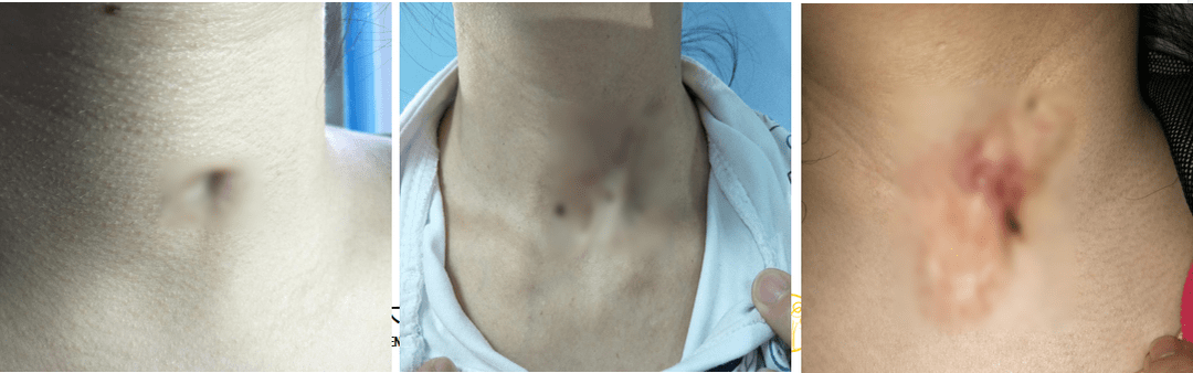 颈部先天性瘘管图片