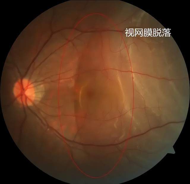南阳南石眼科 | 视网膜脱离案例分享_变性_玻璃体_眼球
