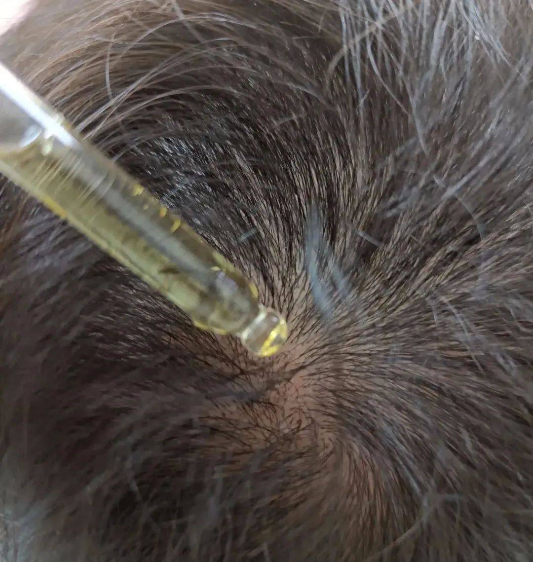 如何预防肾虚性脱发?这几个方面可不能将就