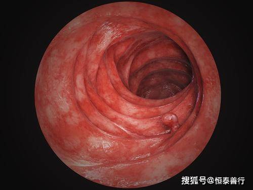 危险"结肠癌"发现即晚期,有这些症状的要注意了……_患者_肠道_肿瘤