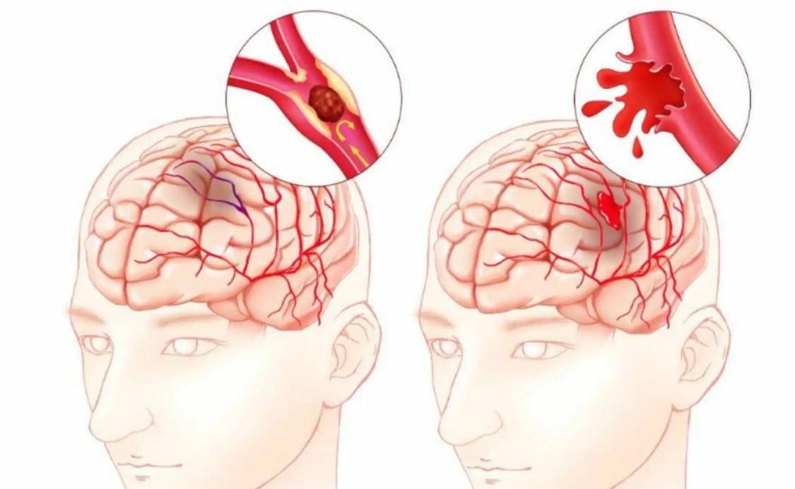 脑血管发病率居高不下,离不开这几个原因,脑科专家孙林娟医生科普