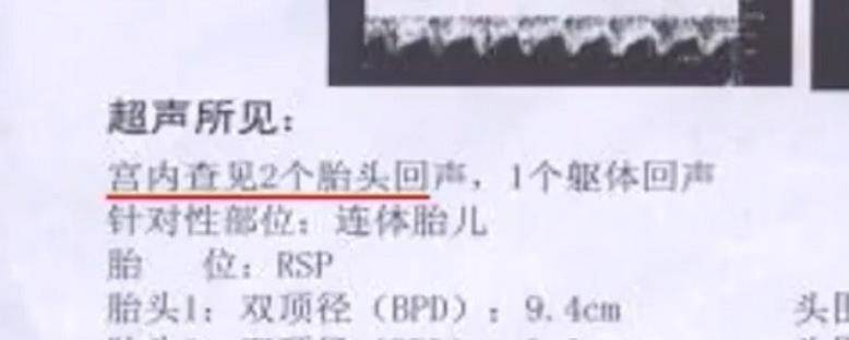 2011年,四川产妇生下国内首例"双头女婴,随后将医院告上法院_包桥英