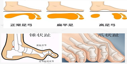 营养不良,肌肉萎缩,屈肌和伸肌失去正常的牵张力平衡,使趾间关节弯曲
