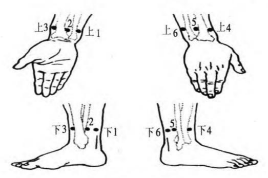 新腕踝针手法及疗效图片
