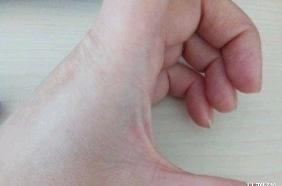 了垂直于虎口与掌纹重合的青筋,且比较明显,就有可能患了心脑血管疾病