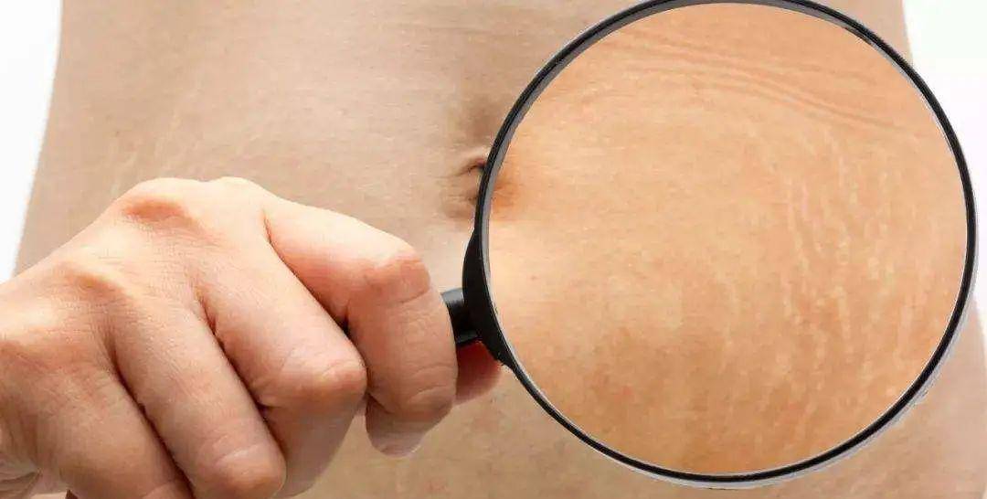 妊娠纹属于膨胀纹的一种,后者还可见于乳房,臀部,大腿等部位.