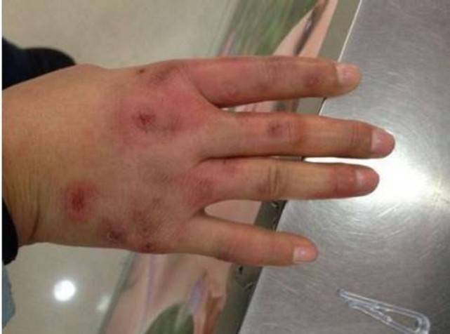 手指冻伤反反复复,又肿又痒!寒冬来袭,这份过来人自救攻略必看!