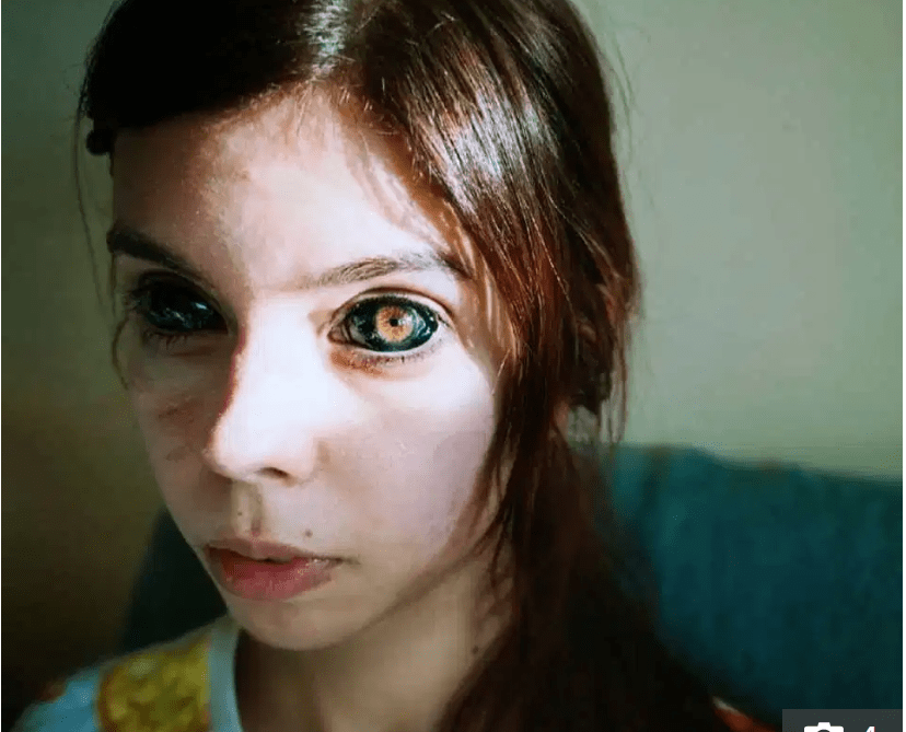 波兰25岁女子追随偶像将眼球纹成黑色不幸失明,网友:像皮蛋_萨多夫