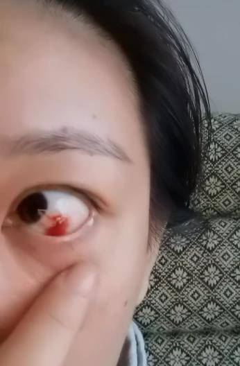 唐一菲与谢娜再度同台合作,节目录制完却将眼睛哭出了血,这是得多用力