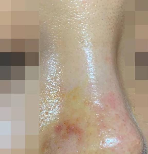 玻尿酸填充鼻基底5天后,发现栓塞了,我该怎么办?_处理_血管_老路