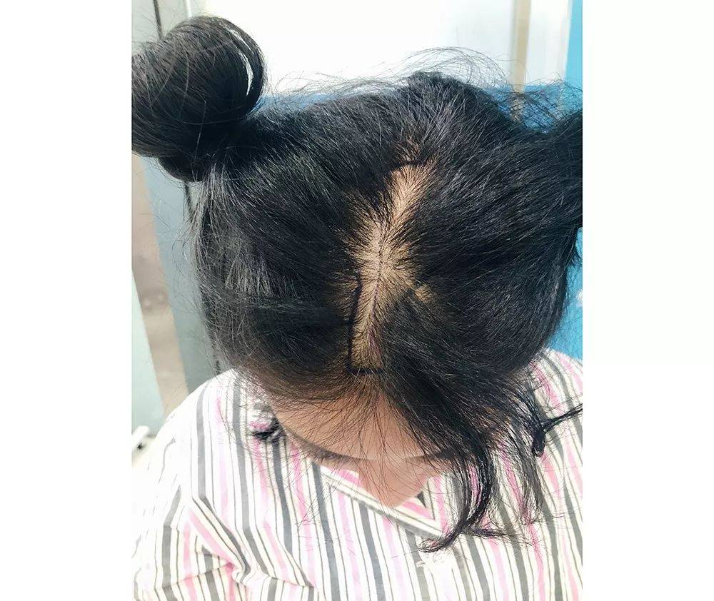 植发后头皮痒得快正常吗_情况_清洗_米诺