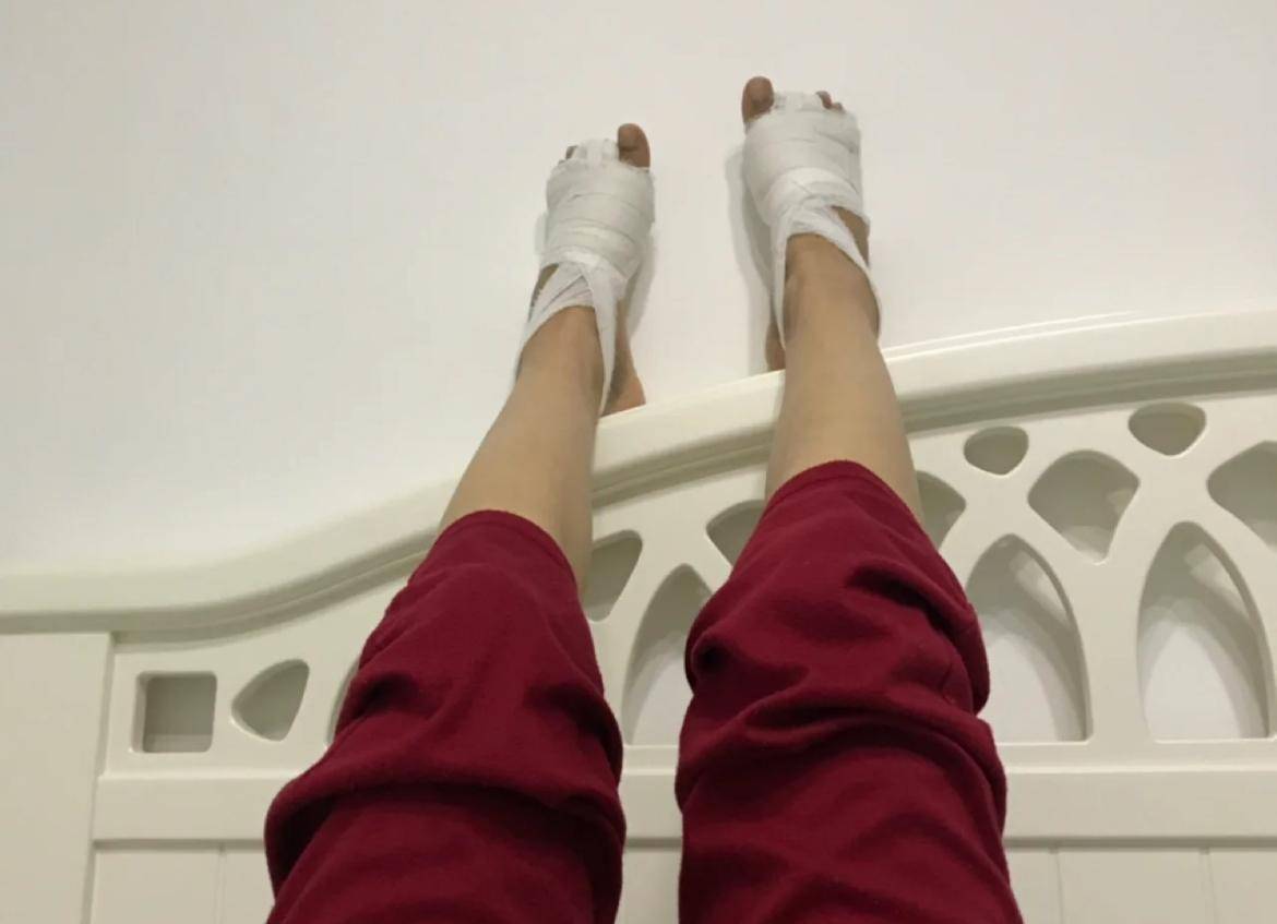 天津45岁女士,和老公吵架后到北京做拇外翻,术后变成"剪刀脚"_脚趾_纪