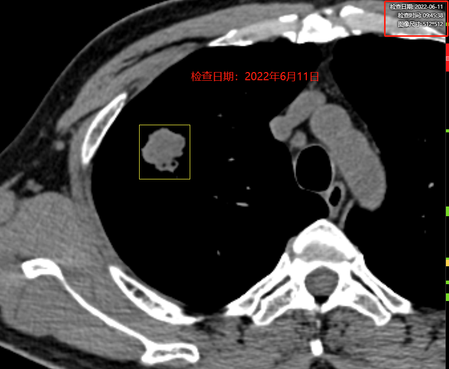 petct病例(8):发现肺结节不重视,造成悲剧,巫医生也很痛心_检查_进行