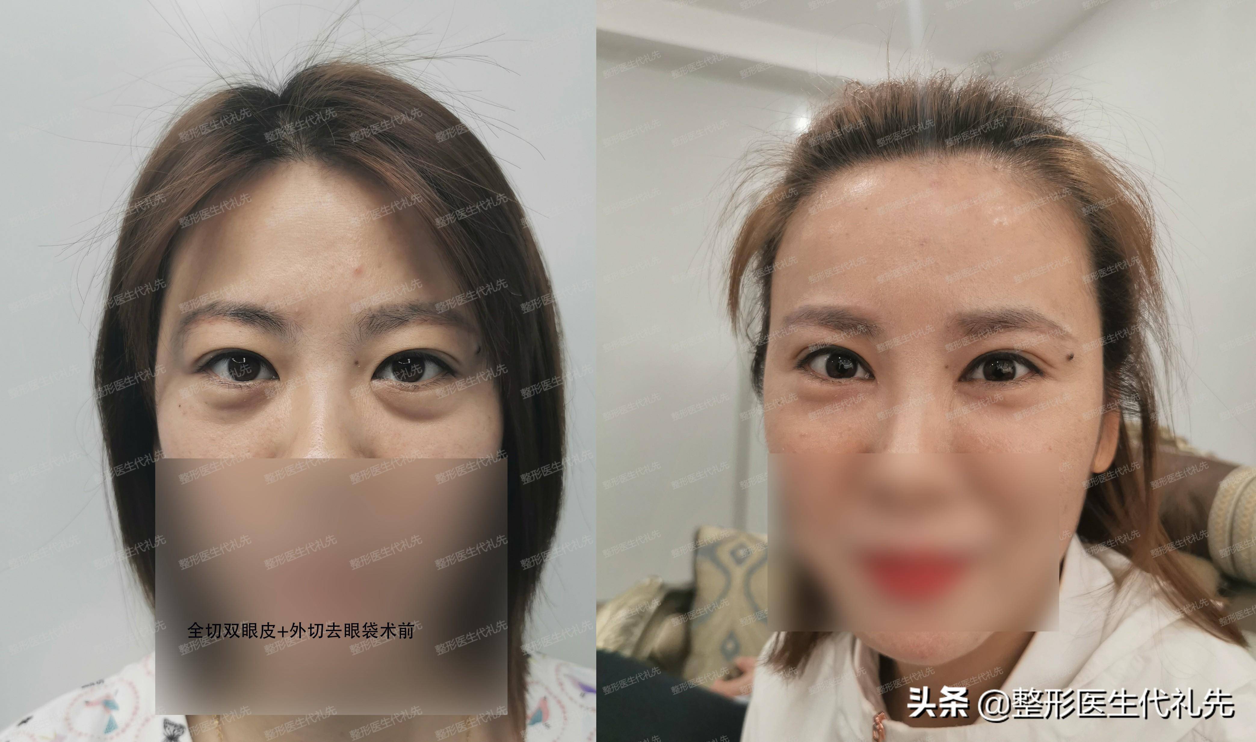眼轮匝肌肥厚型眼袋,42岁女士眼袋案例