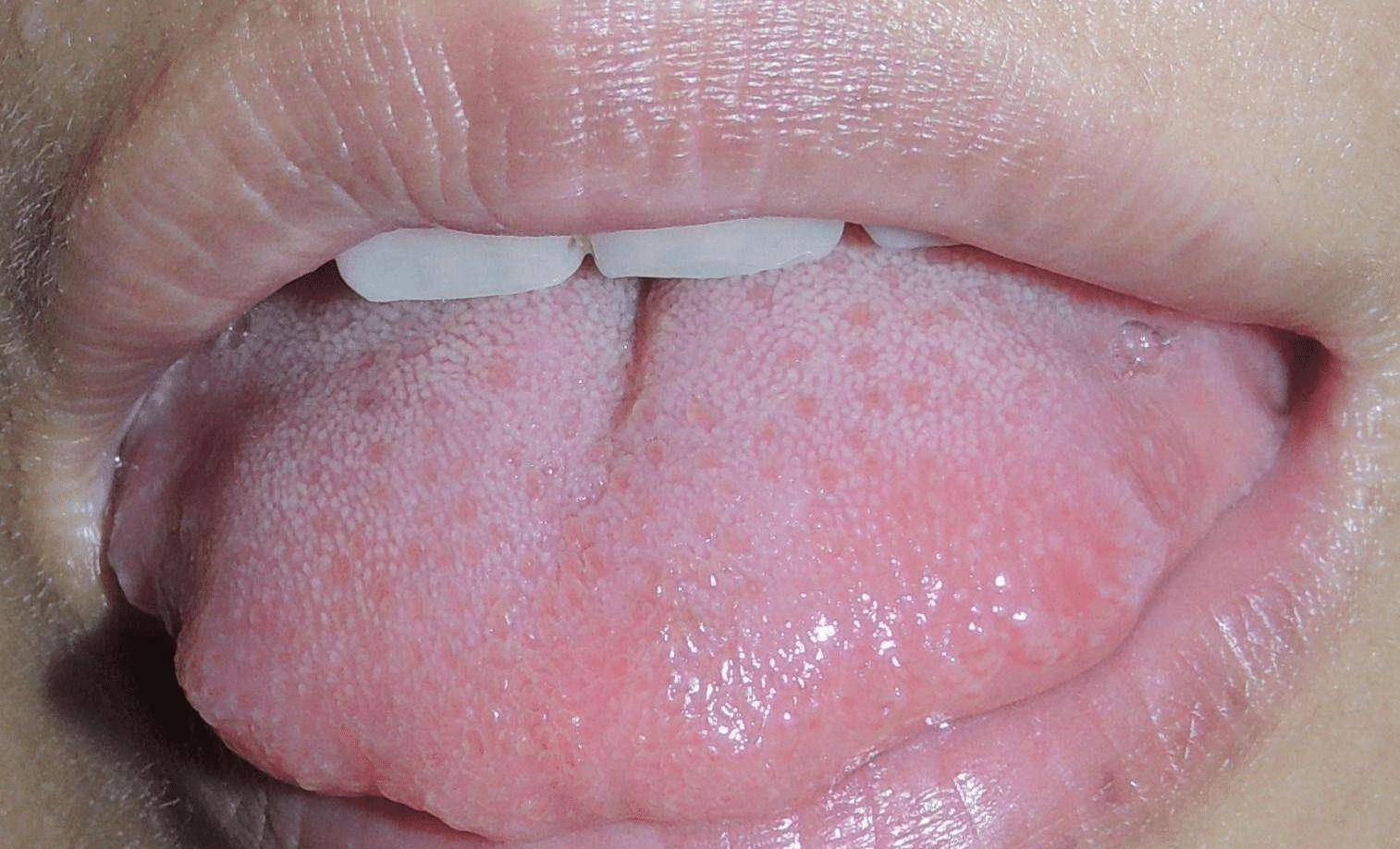 舌体胖大有齿痕,或是3种疾病在"报警",中医教你