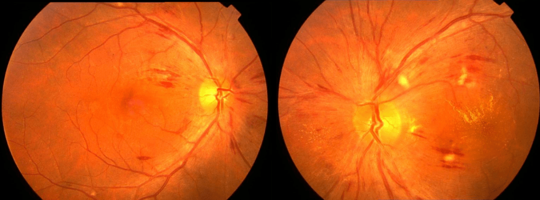 和变细,动脉反光增强;高血压性视网膜病变可分为4级正常的眼底照片