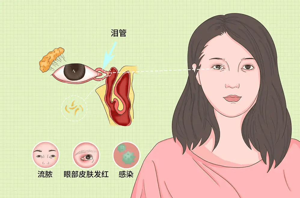 淚道_眼睛_陳偉