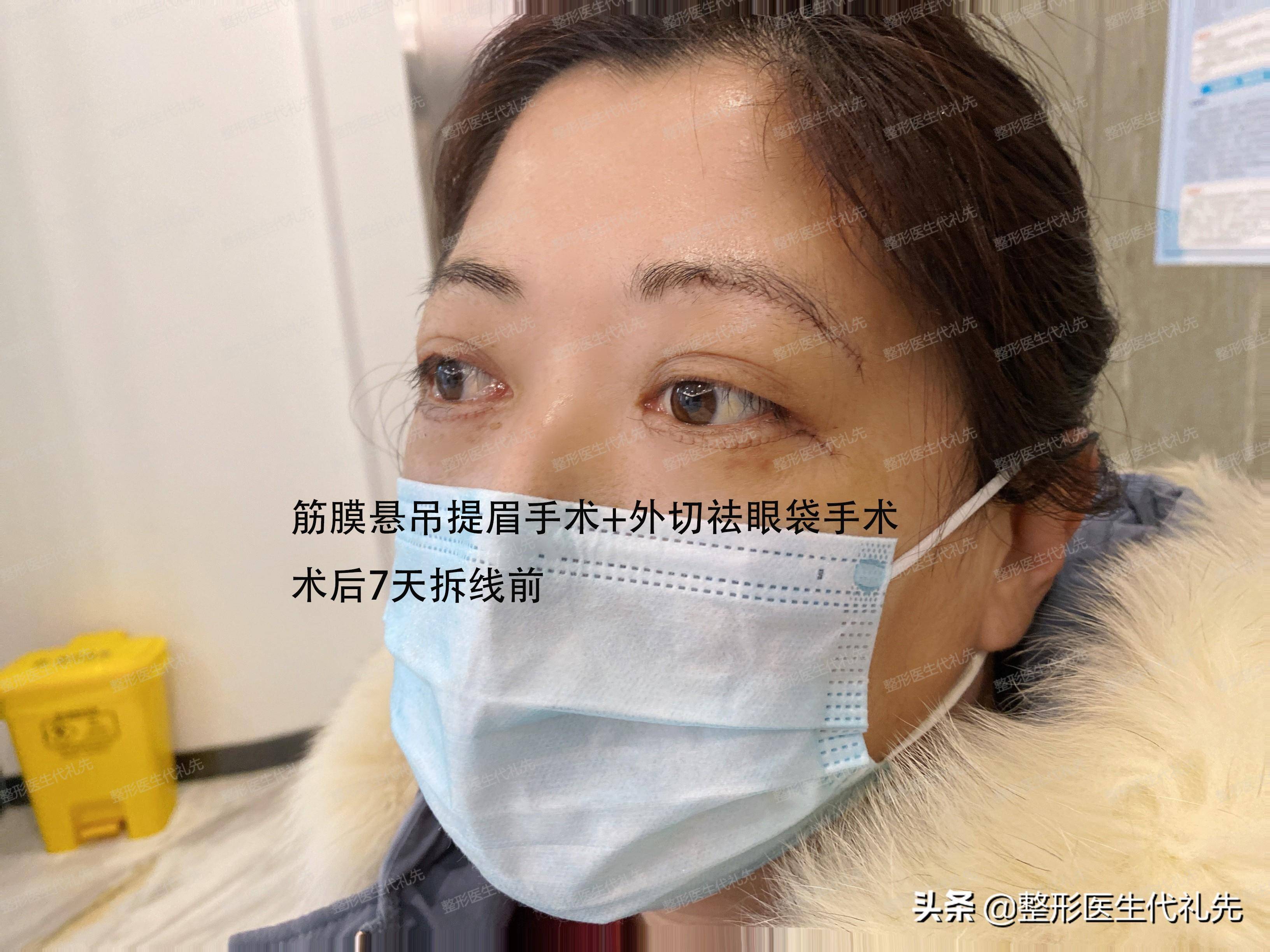 猶豫了1年多想要提眉手術,提眉手術後7天,姐妹們說我年輕10歲_醫生