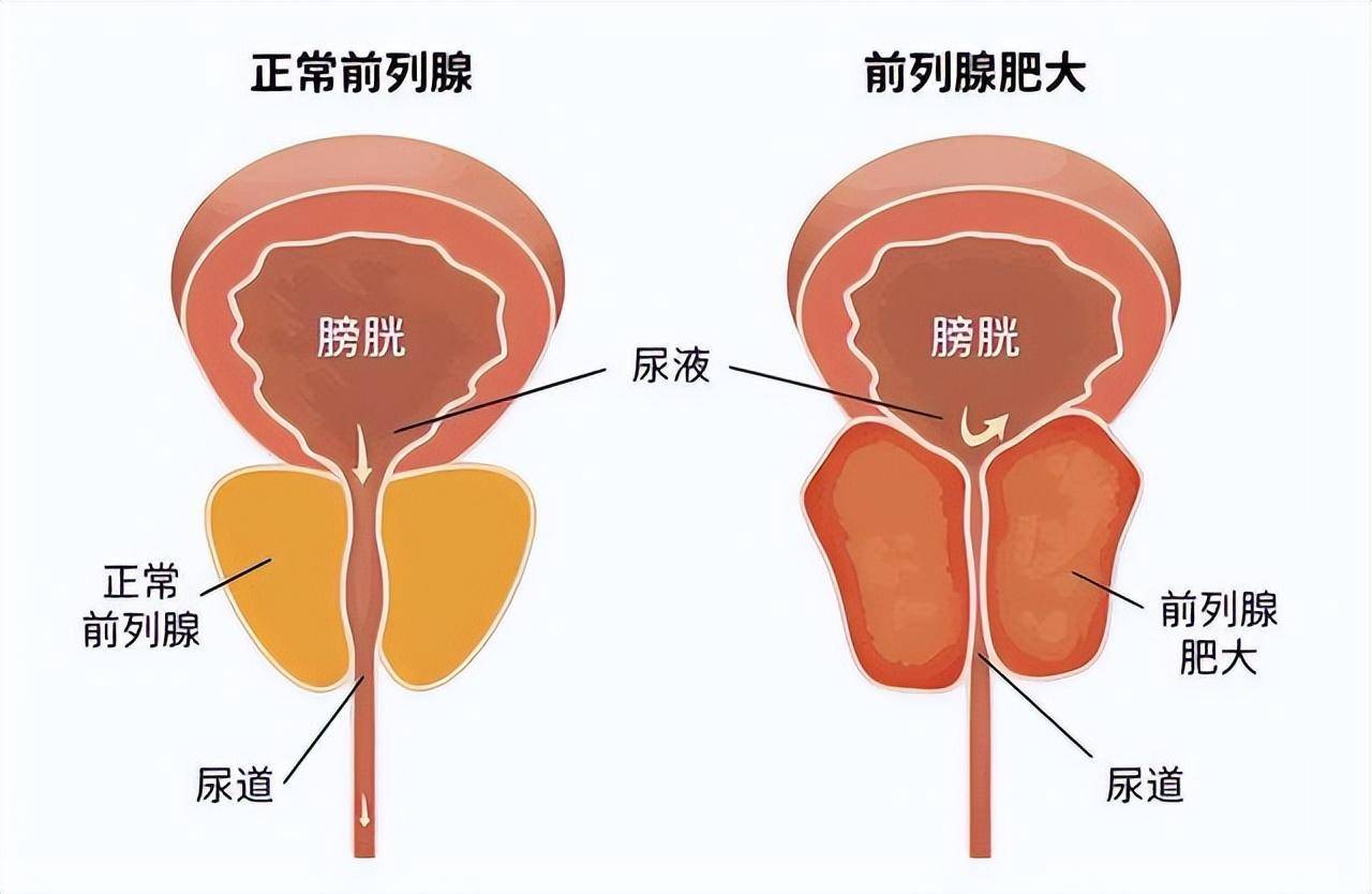 前列腺肥大示意圖還是以黃河舉例,為什麼黃河在上游和中游就很少