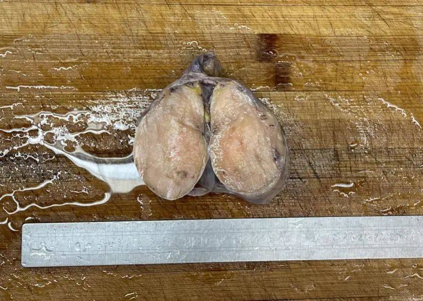 【病例分享】睾丸原发弥漫大b细胞淋巴瘤1例_肿瘤_鉴别_患者