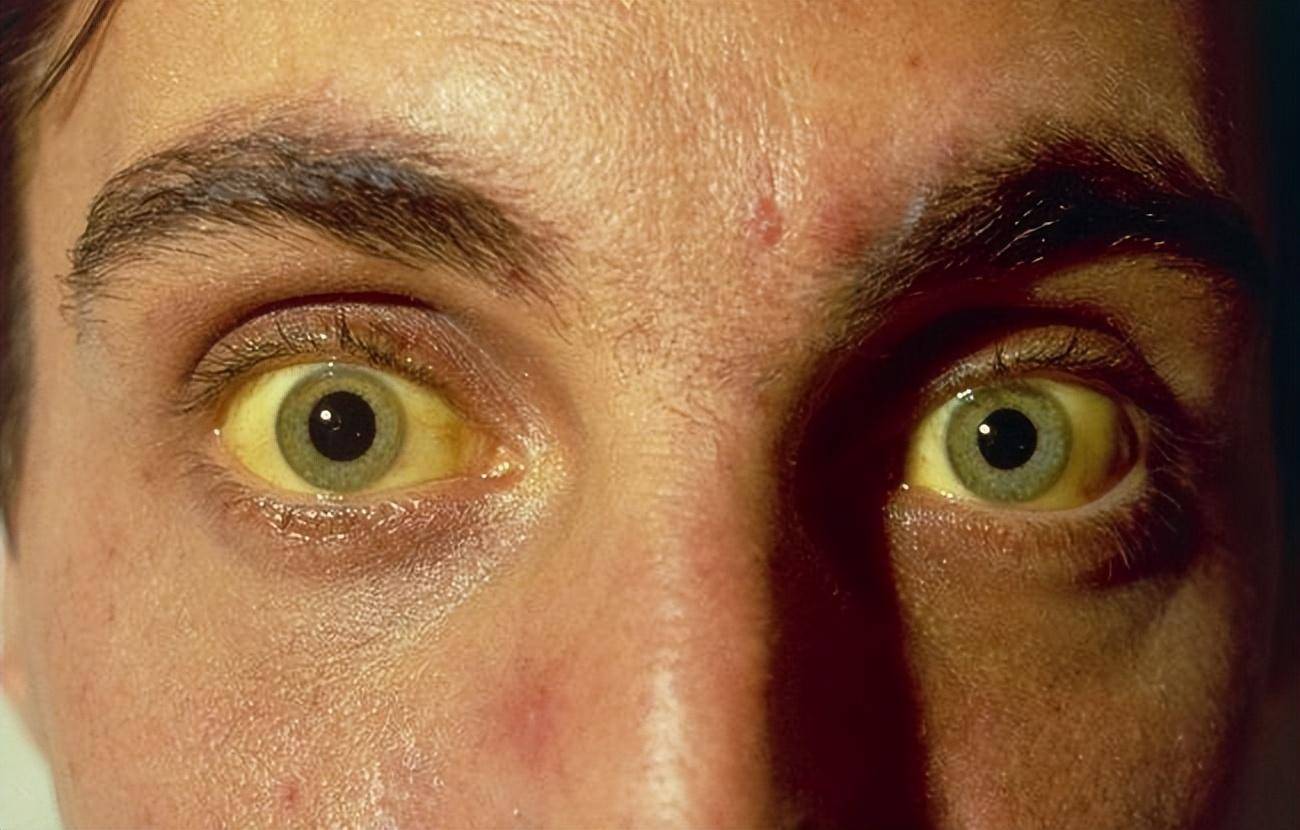 眼睛巩膜发黄的迹象,可能是肝脏受损所致,这也是黄疸的典型表现,肝炎