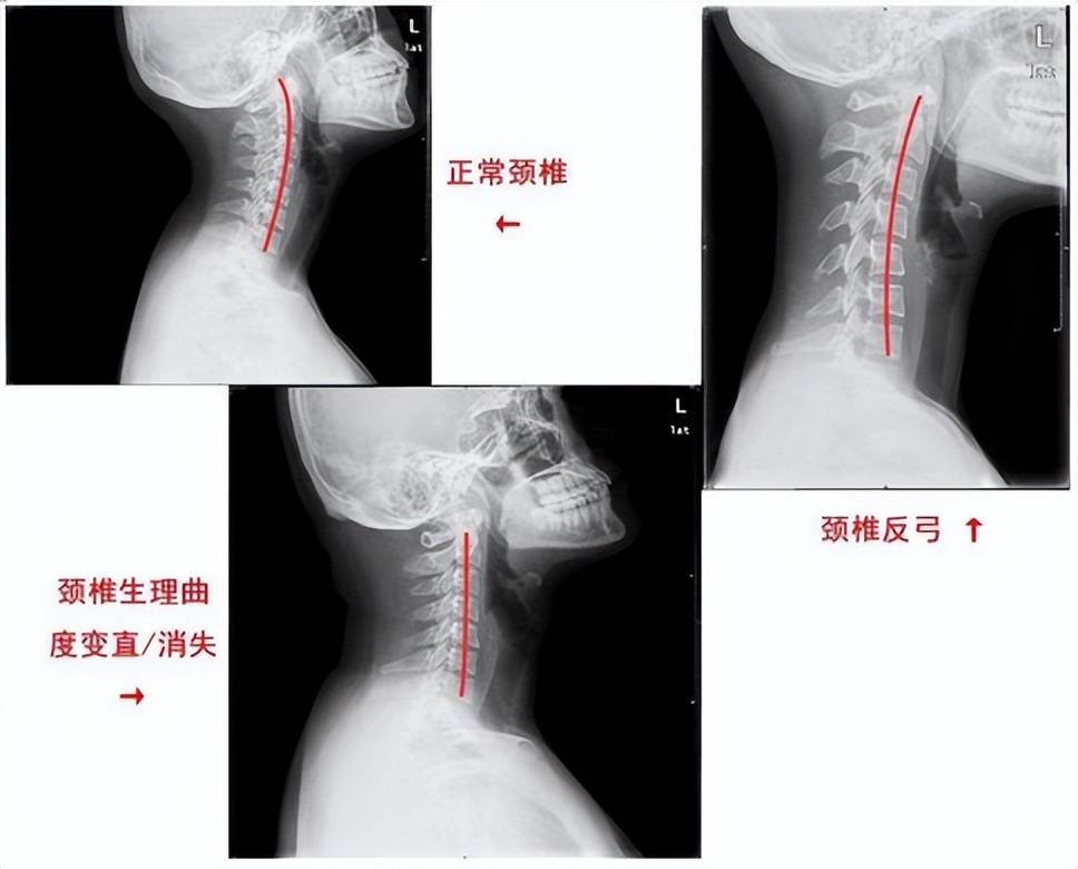 也是用来枕脖子的,枕头太高或太低,都会影响到颈椎的自然曲度,导致