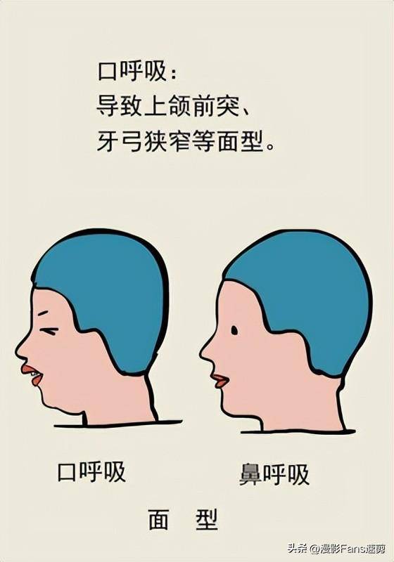 长期口呼吸会导致腺样体面容,导致骨骼发育异常,下巴后缩,引发牙列不