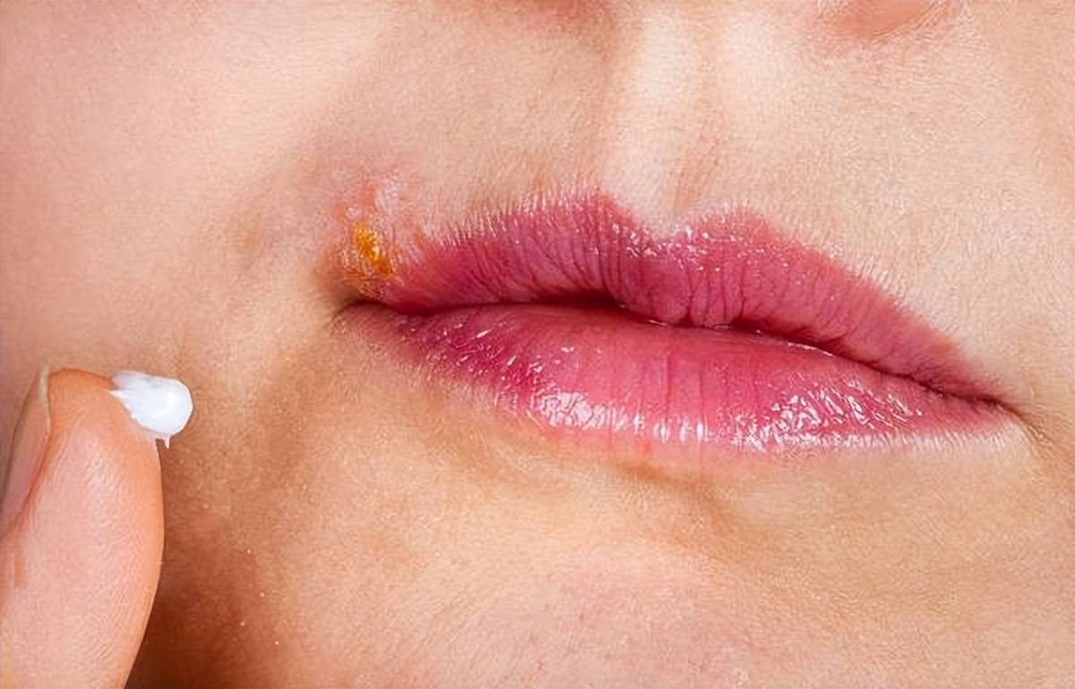 春季嘴唇上长水泡是什么原因 如何治疗？