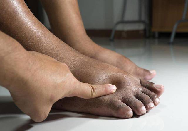 脚部若没有4个异常,祝贺!血糖很稳定_高脂肪_饮食_食物