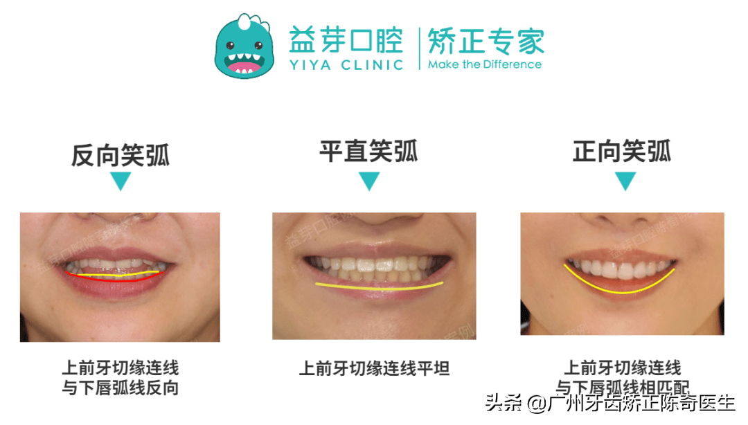 一起解锁自信笑容_牙齿_调整_弧度