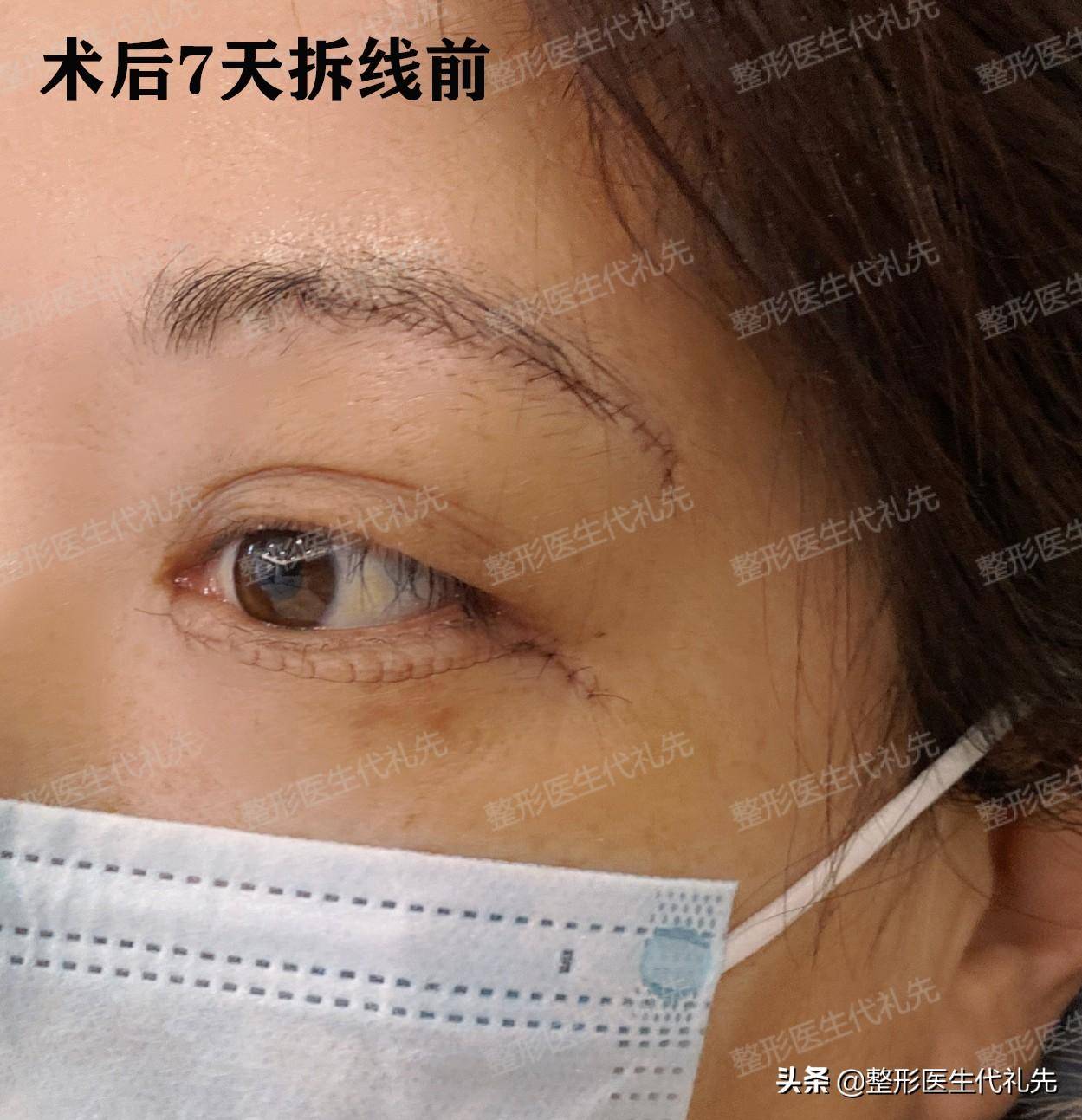 55岁做为一个做过"提眉手术"的人,我来讲讲术后恢复的"真相"_眼睛_松