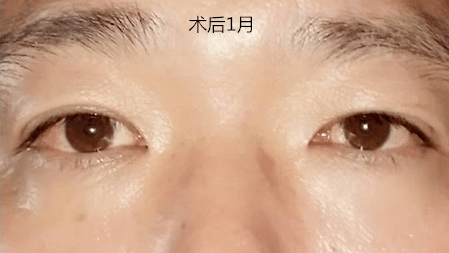 南陽南石眼科 | 別小看斜視眼,再進一步就是弱視了,矯正要趁早_治療