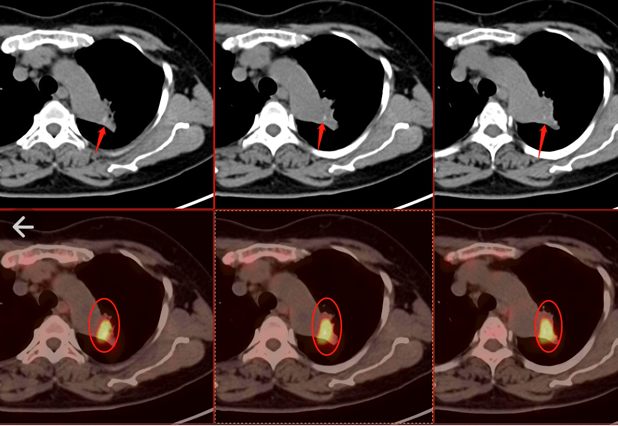 继发于肺结核,慢阻肺,肺纤维化……肺部疾病引起的瘢痕癌_检查_病灶