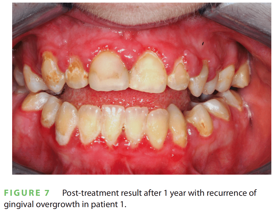 pten错构瘤综合征:口腔临床医生如何挽救生命