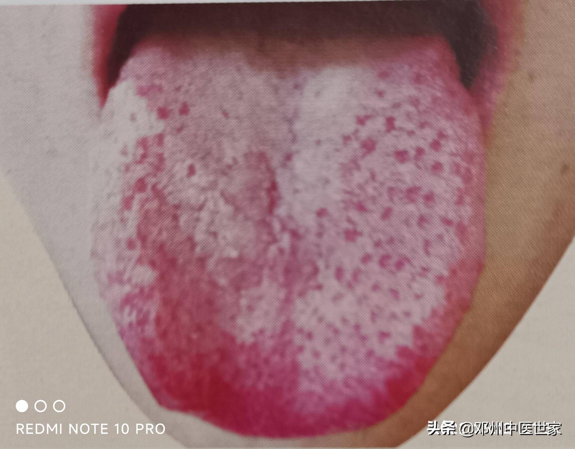 胁痛,肝络失养的舌象_当归_沙参_枸杞子