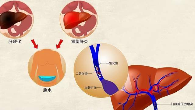 扶正化瘀片逆转肝硬化图片