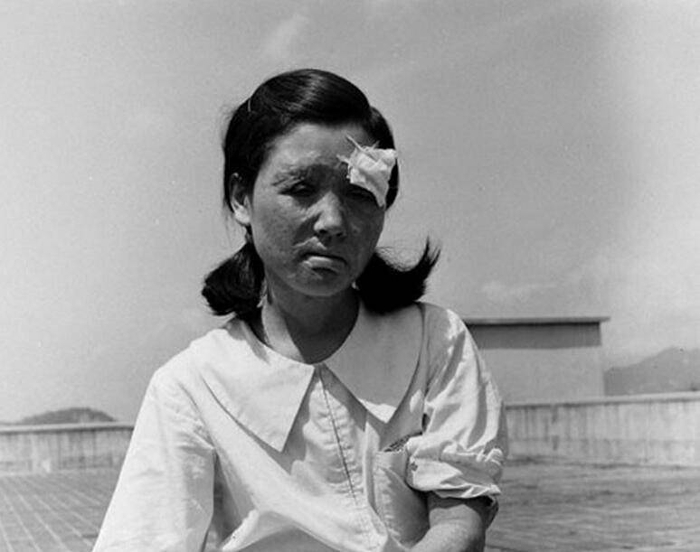 广岛长崎原子弹幸存者:生不如死,充满绝望,身体皮肤狰狞恐怖_爆炸