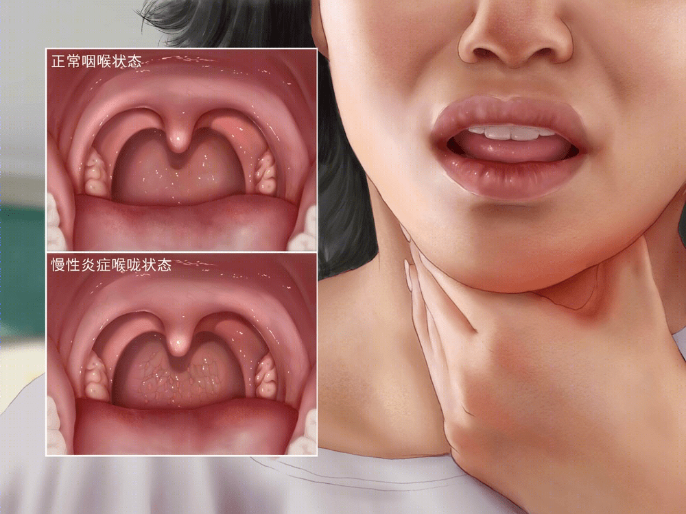 南昌博大耳鼻喉:反复发作的慢性咽炎真的无解吗?