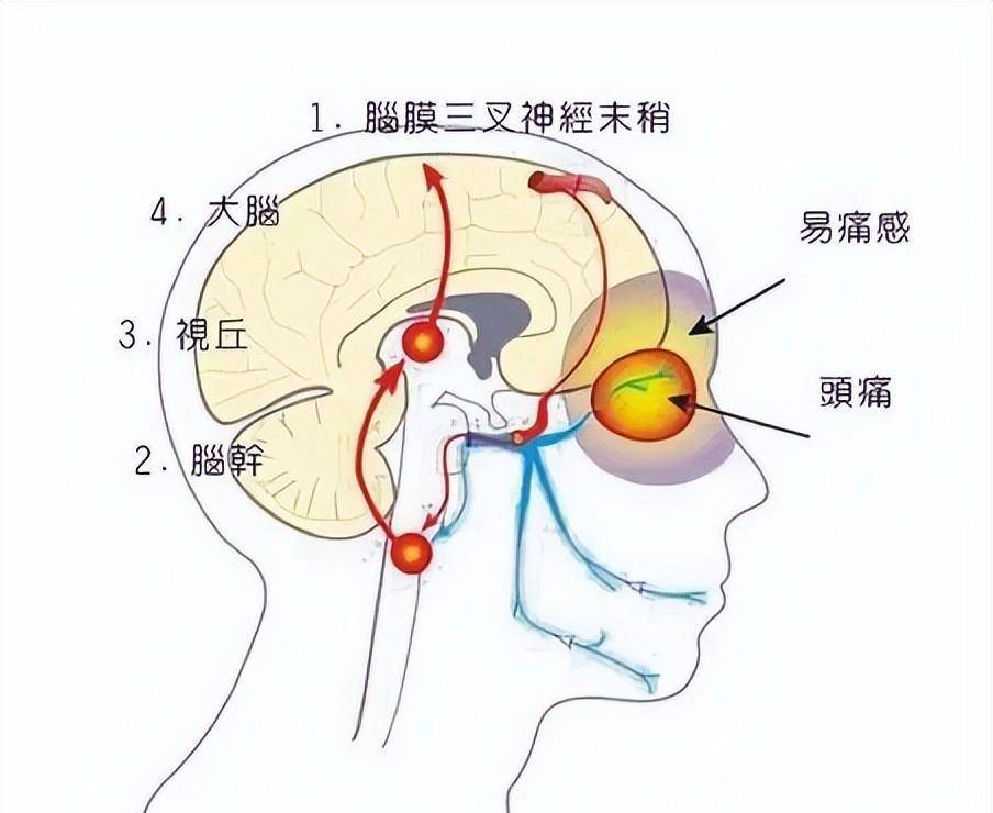 偏头痛图片原因图片