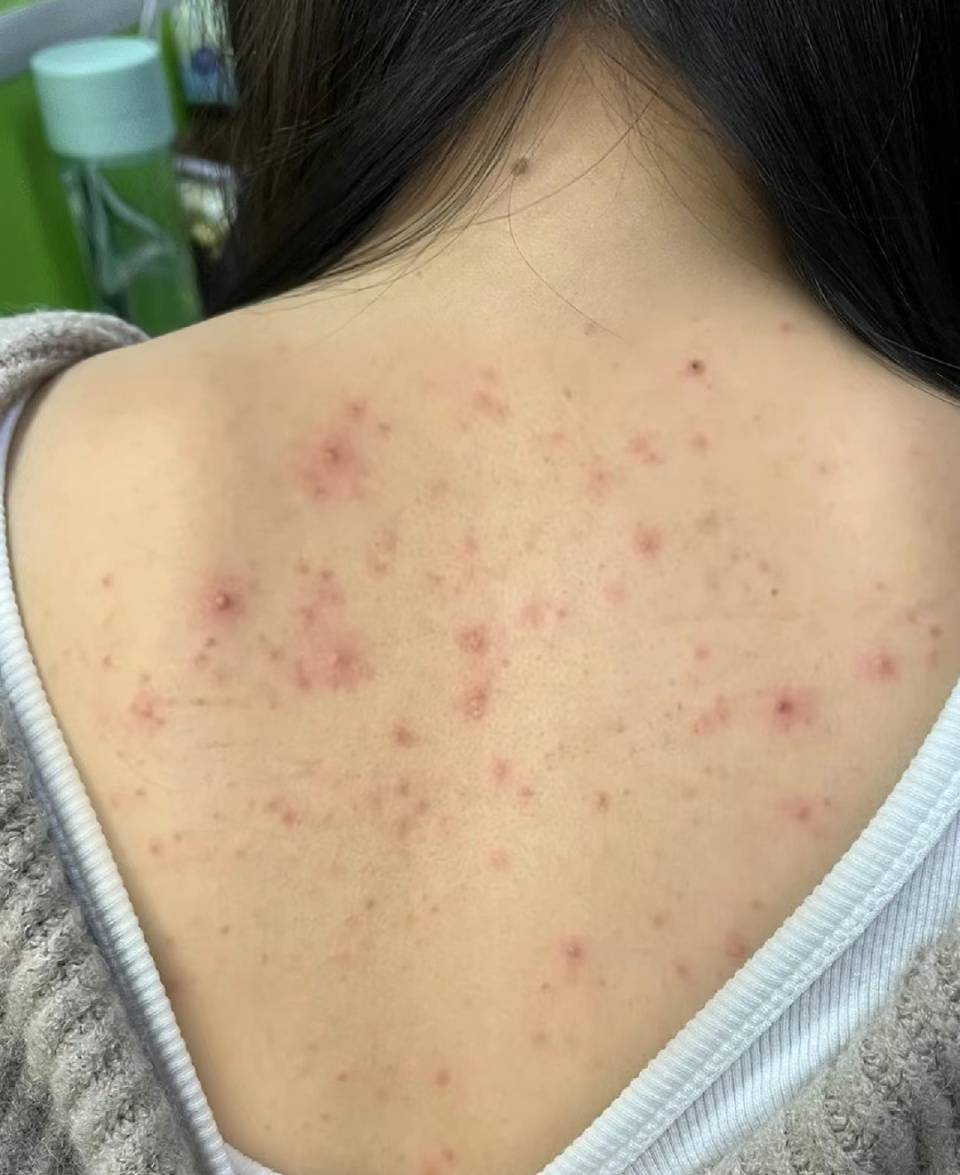 前胸后背疯狂爆痘?过来人分享自用好物,在家就能轻松祛痘!